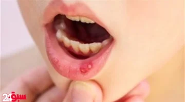 تغذية طفلك المصاب بالهربس: قائمة أطعمة تعزز شفاءه وتخفف أعراضه المؤلمة